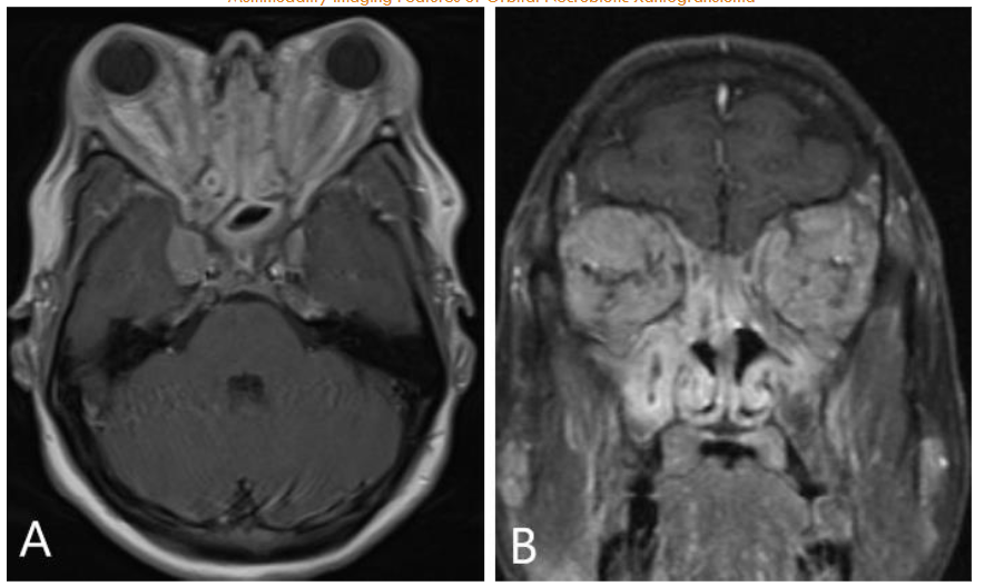 Figure 5: IgG4-RD orbital involvement; Axial and coronal post contrast fat saturated T1 weighted images show widespread infiltrative soft tissue throughout the bilaterally, encasing the extraocular muscles and optic nerves in this patient with. Note widespread mucosal thickening throughout the paranasal sinuses.