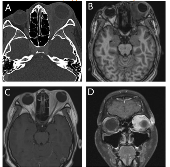 Figure 6: Orbital pseudotumor; Axial orbital CT scan shows left retro-orbital soft tissue thickening and mild pre-septal edema. Note well aerated visualized paranasal sinuses and intact adjacent bones. Axial precontrast T1WI and axial and coronal post contrast T1WI show multispatial enhancement of the left retro-orbital space that is both extra- and intraconal without discrete mass.