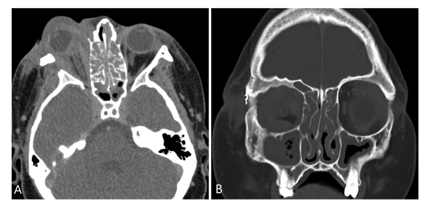 Figure 1: Axial and coronal orbital CT scan show soft tissue involving both pre- and post- septal fat with intraconal and retrobulbar extension. Note diffuse opacification of paranasal sinuses and thickening and the superior and lateral walls of the right orbit secondary to chronic inflammation.
