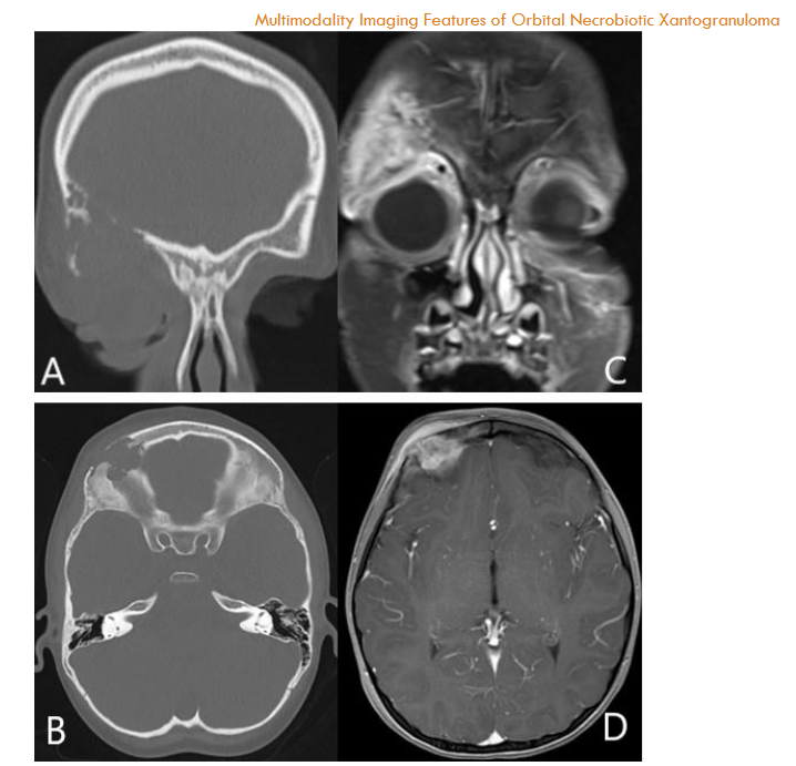 Figure 4: Langerhans cell histiocytosis; Coronal and axial orbital CT scans show ill-defined lytic lesion in the right aspect of the frontal bone involving the orbital roof. Coronal and axial post contrast T1 Weighted fat saturated images show enhancing and destructive centered on the right frontal bone superior orbital rim. The mass invades the right lacrimal gland with mild flattening of the superolateral right globe.