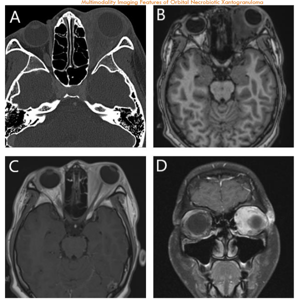 Figure 6: Orbital pseudotumor; Axial orbital CT scan shows left retro-orbital soft tissue thickening and mild pre-septal edema. Note well aerated visualized paranasal sinuses and intact adjacent bones. Axial precontrast T1WI and axial and coronal post contrast T1WI show multispatial enhancement of the left retro-orbital space that is both extra- and intraconal without discrete mass.
