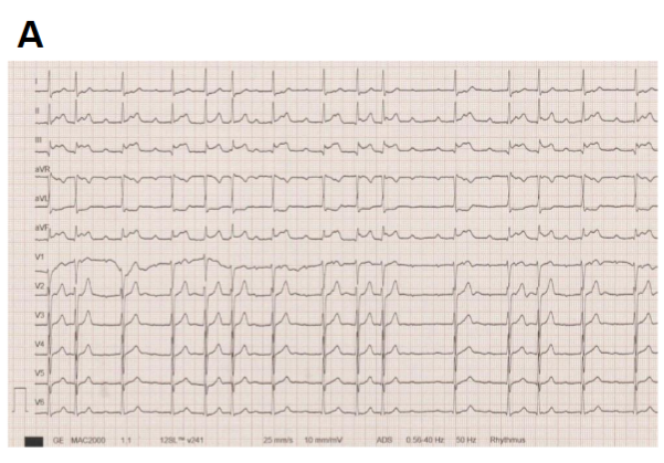 Myocardial Infarction in Young Adults: A Case Study - European Society ...