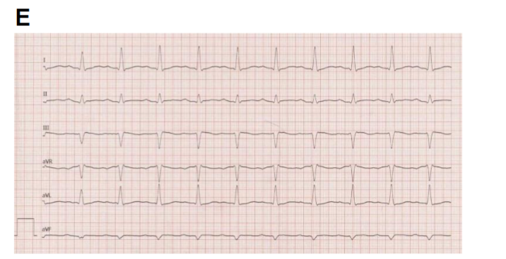 Myocardial Infarction in Young Adults: A Case Study - European Society ...