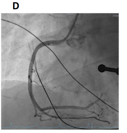 Myocardial Infarction in Young Adults: A Case Study - European Society ...