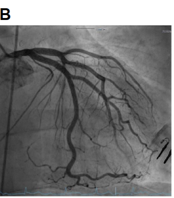 Myocardial Infarction in Young Adults: A Case Study - European Society ...