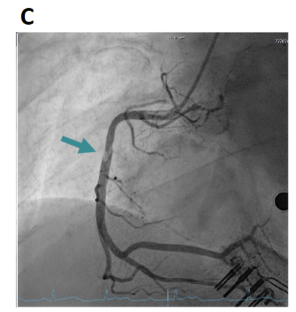 Myocardial Infarction in Young Adults: A Case Study - European Society ...