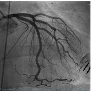 Figure 2: Left coronary artery without significant stenosis.