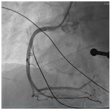 Figure 4: Coronary angiogram after PTCA/Stenting.