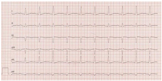 Figure 5: ECG after intervention.