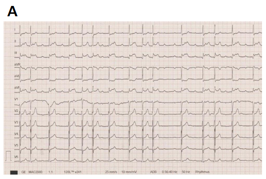 Figure 1: Initial ECG showing ST segment elevations as well as a second-degree atrioventricular block (Mobitz Type II).