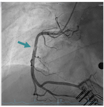 Figure 3: Right coronary artery revealed a subtotal occlusion of the RCA and high thrombus burden.