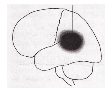 Fig. 5. Lesion site (in black) situated in the region of the PTO (parieto-temporo-occipital) junction associated with the loss of dreaming and the preservation of REM sleep (Solms, 2003).