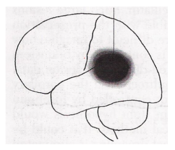 Fig.5. Lesion site (in black) situated in the region of the PTO (parieto-temporo-occipital) junction associated with the loss of dreaming and the preservation of REM sleep (Solms, 2003).
