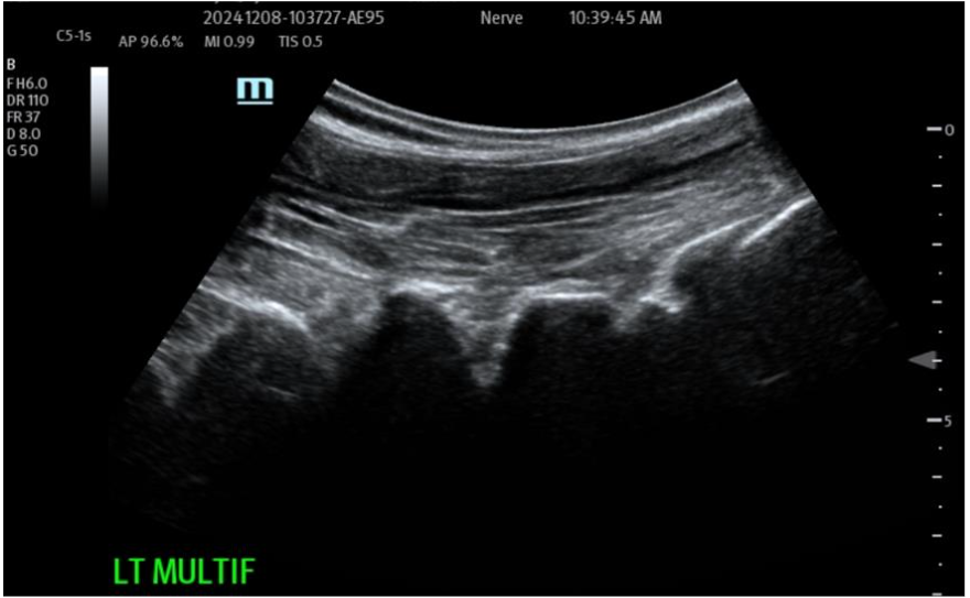 Figure 3A: Pre- and Post-Treatment Nanofat + HD PRP Back: Multifidus SAX
