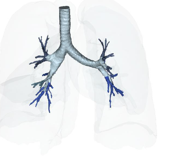 Figure 16A: Restoration of the near terminal Tracheobronchial tree, pre-treatment showing blunting and loss of distal bronchioles.