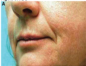 Figure 5A: Pre-Operative Facial Skin, Treatment tSVF + HD PRP