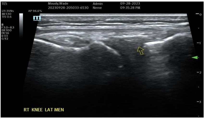 Figure 7A: Pre-Treatment Medial Meniscal/MCL Damage and Inflammatory Changes