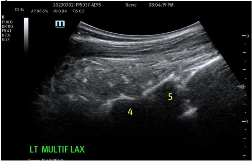 Figure 3: Post-operative remodeling with dynamic return of function, marked relief of LBP. NOTE: Lumbar Facets treated at this same procedure