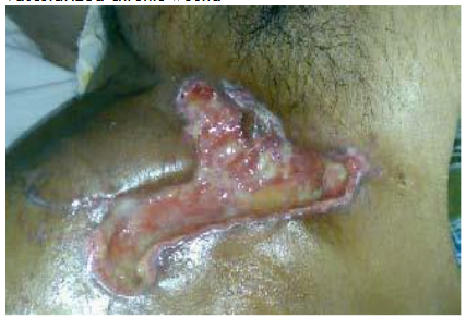 Figure 3B: Post-Biocellular treatment (18 mon.) Piriformus Syndrome