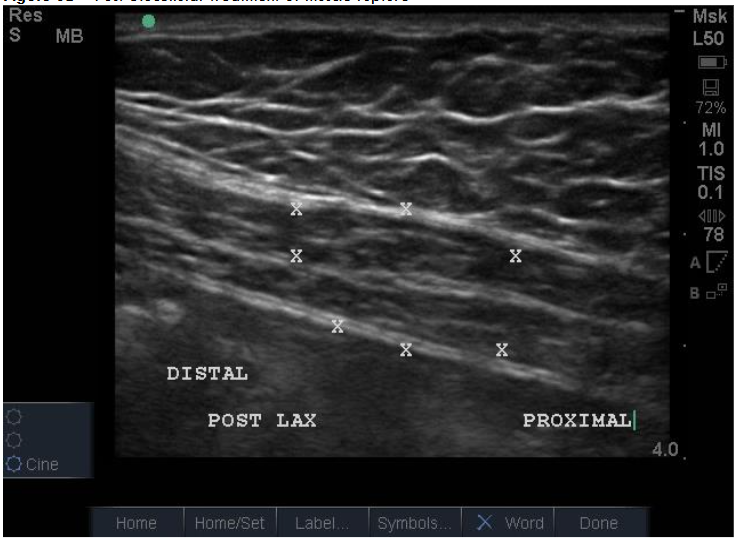 Figure 8A: Traumatic Rupture Right Rectus Abdominus (American Football Helmet) Defect, Pre-Treatment at 48 hours