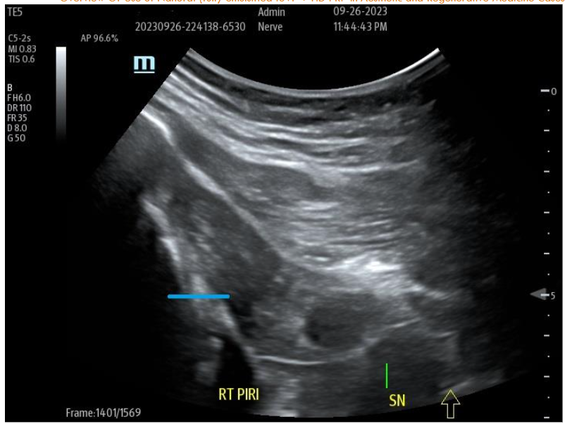 Figure 9A: Pre-Treatment U/S of degenerative Piriformis (sciatic radicular symptoms) no history of trauma, degenerative Pattern within Piriformis musculature with loss of muscle echotexture.