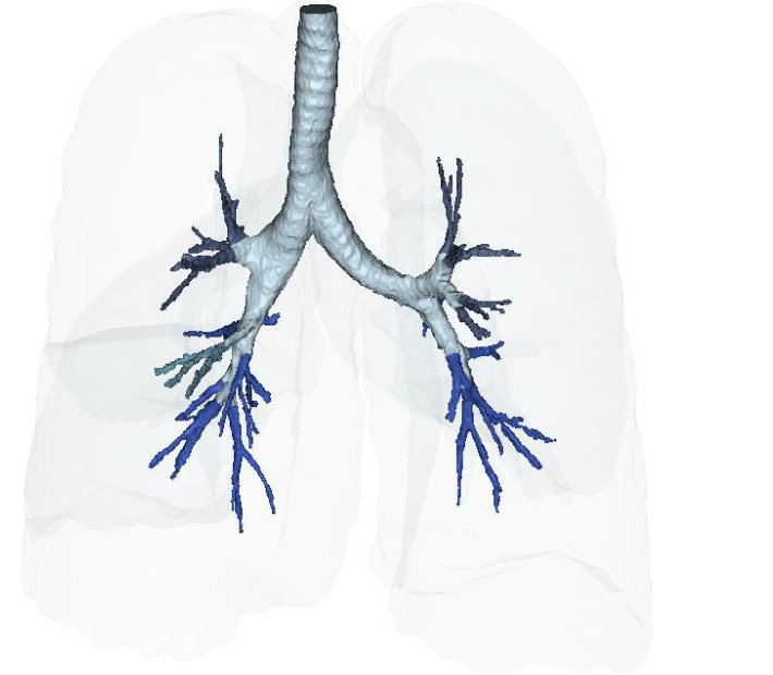 Figure 16B: Post-treatment IV cSVF with elongation of distal bronchiolar tree at six months.