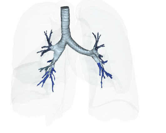 Figure 16A: Restoration of the near terminal Tracheobronchial tree, pre-treatment showing blunting and loss of distal bronchioles