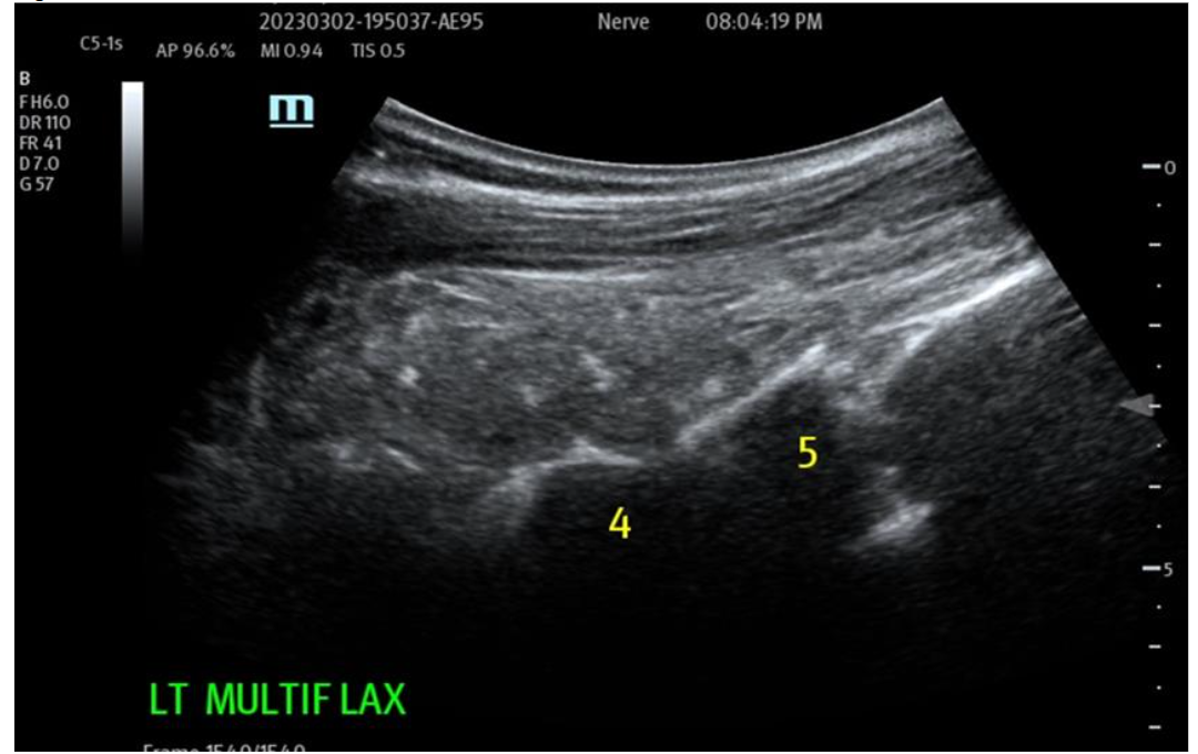 Figure 3A: Pre- and Post-Treatment Nanofat + HD PRP Back: Multifidus SAX