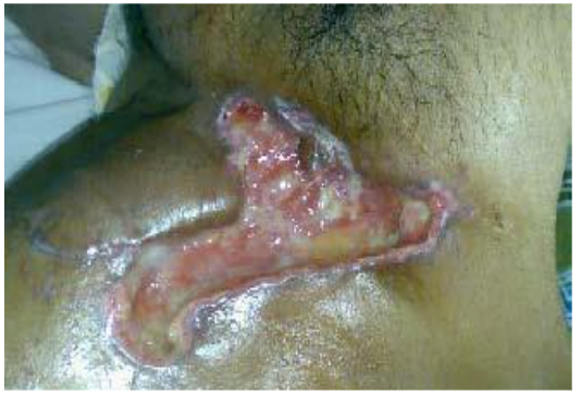 Figure 4. A,B,C: Example of non-healing, poorly vascularized chronic wound