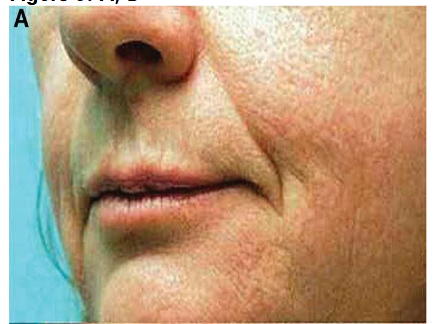 Figure 5A: Pre-Operative Facial Skin, Treatment tSVF + HD PRP