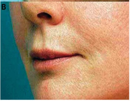 Figure 5B: Post-Treatment at 1 Year following subdermal tSVF and HD PRP. Note: pore size reduction, Maintained volumetric therapy at cheeks, nasolabial fold, lip area, much improve vascularization.
