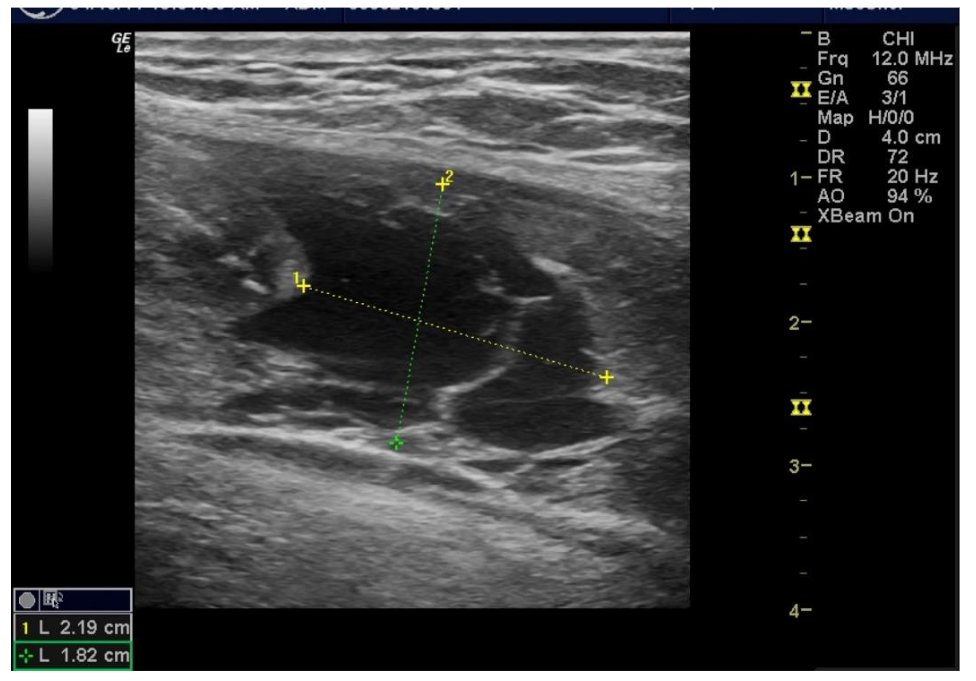 Figure 8A Traumatic Rupture Right Rectus Abdominus (American Football Helmet) Defect, Pre-Treatment at 48 hours