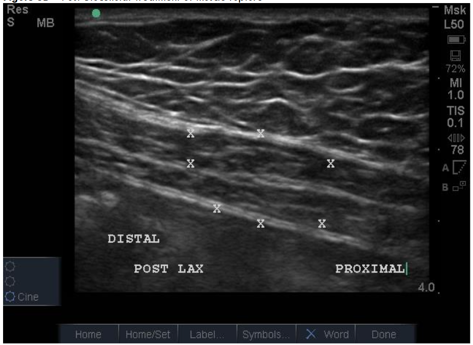 Figure 8B Post-Biocellular treatment of muscle rupture