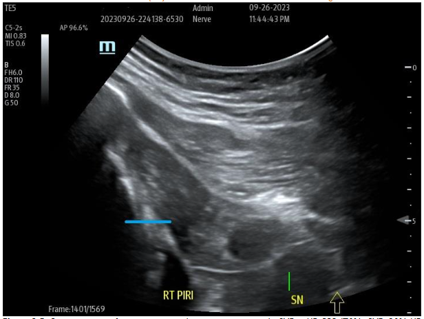 Figure 9B: Post-treatment of site at nine months post-treatment with tSVF + HD PRP (70% tSVF: 30% HD PRP (6X - concentration HD PRP) with return of improved muscular echotexture and elimination of radicular sciatic symptoms.