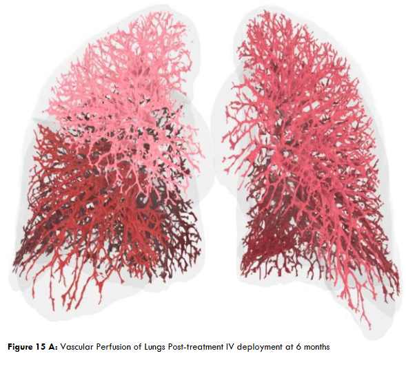 Figure 15B: Post IV deployment cSVF therapy in Long COVID-19 clinical trial NCT04326036 at 6 months. NOTE: Improved perfusion, throughout, but particularly in the lower distal lung