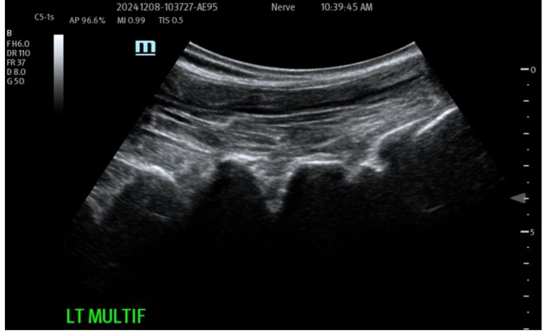 Figure 3B: Post-Biocellular treatment (18 mon.) Piriformus Syndrome