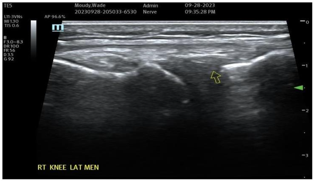 Figure 7B Post-Treatment with Biocellular Product (Orthobiologic) mix of Nanofat + HD PRP, this target Medial Meniscus areas (1 target of many in Knee)