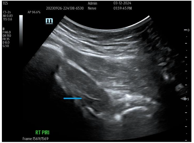 Figure 9A: Pre-Treatment U/S of degenerative Piriformis (sciatic radicular symptoms) no history of trauma, degenerative Pattern within Piriformis musculature with loss of muscle echotexture.