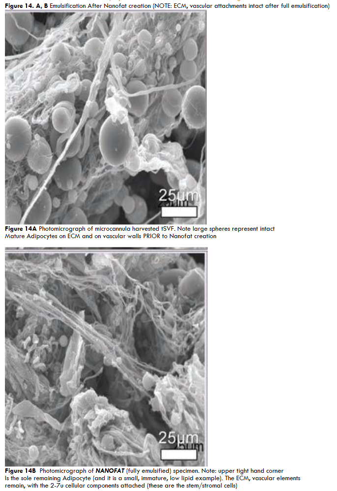 Figure 15A: Vascular Perfusion Changes Pre-treatment of Long COVID-19 lung vascular changes. and post IV cSVF therapy in Long COVID-19 clinical trial NCT04326036