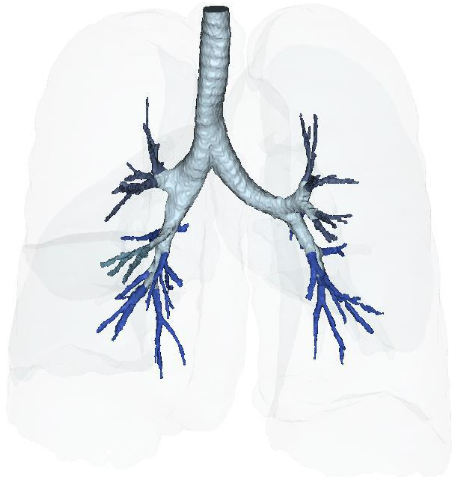 Figure 16B: Post-treatment IV cSVF with elongation of distal bronchiolar tree at six months. NOTE: With this post-treatment changes with cSVF was an accompanying reduction in airway resistance and pressures within the lung parenchyma. Higher pressures in pre-treatment image were located in the Upper lobes (less efficient and higher pressures in pre-treatment), whereas the shift from upper to lower lung parenchyma accompanied Improve vascular supply and perfusion, and patients no longer experienced difficulties in inhalation capabilities.