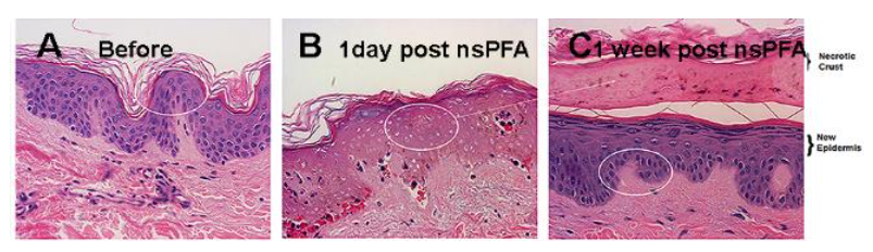 Figure 2. Time course of human epidermal viability loss and recovery. A. Thin section of untreated human skin stained with H&E; B. One day after nsPFA treatment; C. One week after nsPFA treatment; necrotic epidermis from B has the appearance of a crust and is delaminating from the new epidermal layer (oval). (reprinted with permission)