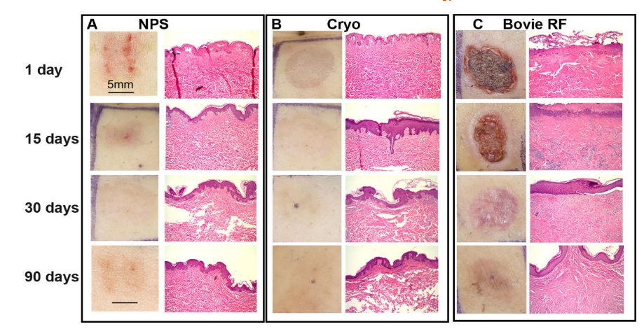 Figure 1. Surface photograph and corresponding histological section collected from human abdominal skin treated with the method indicated at the top of each column at the time point shown on the left. (A) NPS therapy applied at 130 mJ/mm3 with a 5 X 5 mm tip; (B) Three seconds of cryoablation; (C) A few seconds of Bovie RFA ablation on a Bovie setting of 10. Scale bars on the upper left apply to all similar image types. (reprinted with permission)