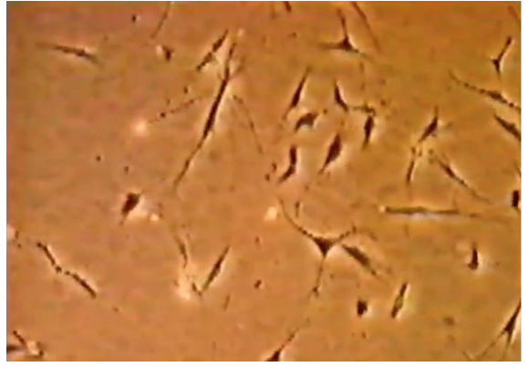 Figure 6: Top, Micrograph from inverted microscopy demonstrating the Natural Multipotent Stem Cell (nMS) Lineage after sub-culture from gingival biopsy tissue, cultural condition as described as Figure 5, cells are crawling on the plate, fully alive, active, sterile, clean and no foreign debris, free of contamination, original magnification x 300; Bottom, nMS, original magnification x 600. Harvested finished product nMS in shipping buffer, was stable at ambient temperature and general environment for up to seven days or more, without an incubator of 37 °C, CO2, O2, and fixed humidity supplies.