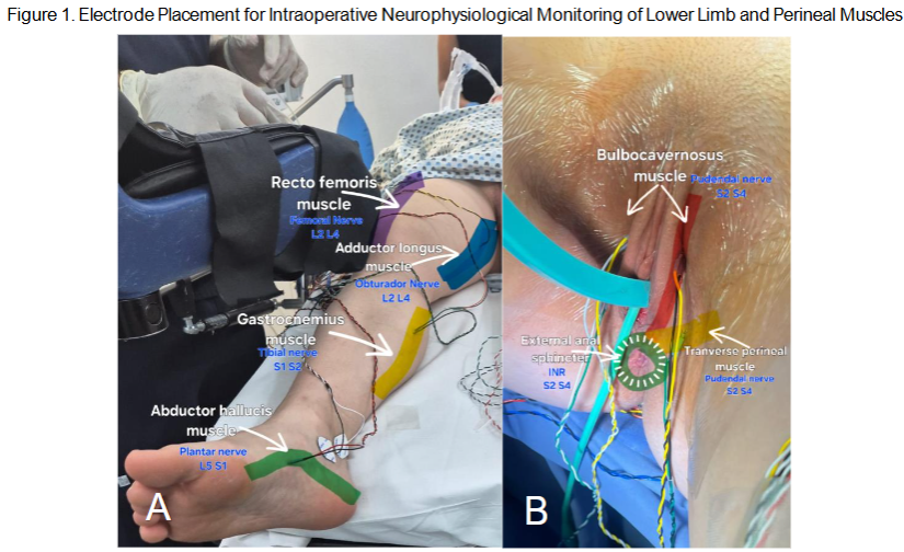 Figure 1. Intraoperative CMAP recordings using subdermal needle electrodes. A. Electrode placement on lower limb muscles: rectus femoris, adductor longus, gastrocnemius, and abductor hallucis. B. Perineal electrodes on bulbocavernosus, transverse perineal, and external anal sphincter muscles. All muscles are innervated by key pelvic and lumbosacral nerves (L2-S4) relevant for surgical neuromonitoring.