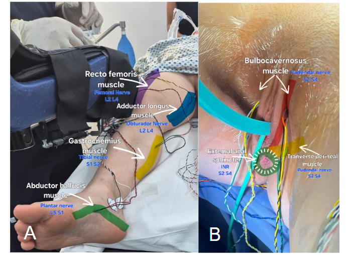 Figure 1. Intraoperative CMAP recordings using subdermal needle electrodes. A. Electrode placement on lower limb muscles: rectus femoris, adductor longus, gastrocnemius, and abductor hallucis. B. Perineal electrodes on bulbocavernosus, transverse perineal, and external anal sphincter muscles. All muscles are innervated by key pelvic and lumbosacral nerves (L2-S4) relevant for surgical neuromonitoring.