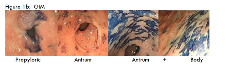 Figure 1b GIM. Chromendoscopy using methylene blue of GIM: GM in prepyloric region, of antrum, of antrum and body of stomach. Lower panel shows chromoendoscopy 6 months after endoscopic mucosal resection using Lam’s technique; there was no recurrence, as confirmed by biopsy (total 8) and histology examination.