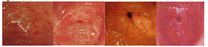 Figure 1a NG. Endoscopy of nodular gastritis (in a 75 years old man with non-specific dyspepsia and heartburn) before and after successful H. pylori treatment. Note that treatment takes months to undergo visual effect of healing.