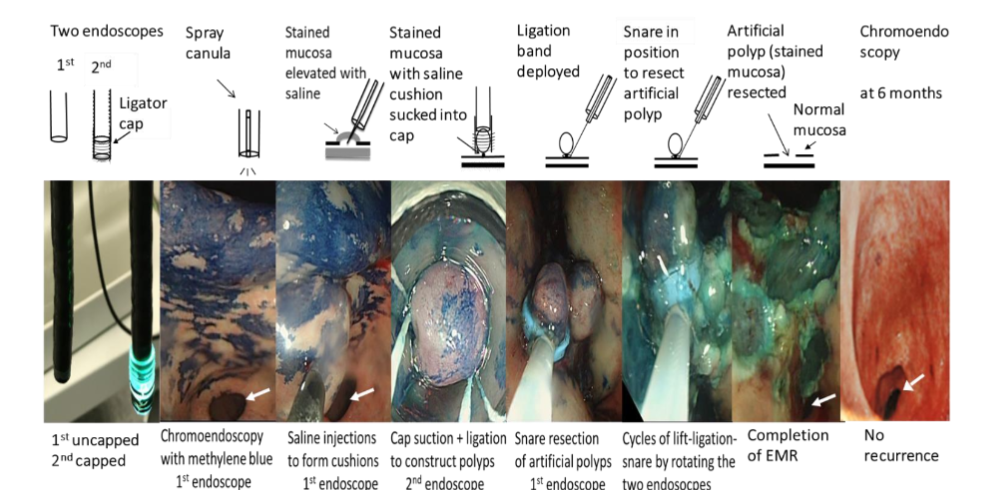 Figure 2: Two-endoscope technique of endoscopic mucosal resection (white arrow indicates pylorus).