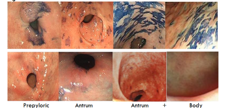 Figure 3. Chromoendoscopy before and after endoscopic mucosal resection using Lam’s technique.