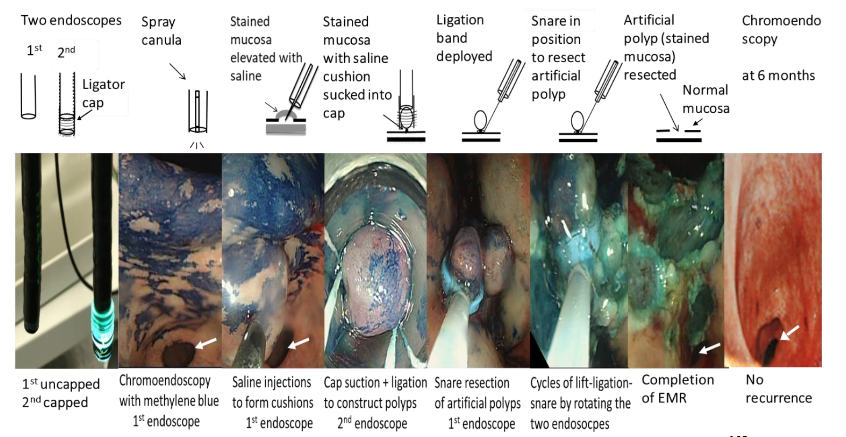 Figure 2: Two-endoscope technique of endoscopic mucosal resection (white arrow indicates pylorus).